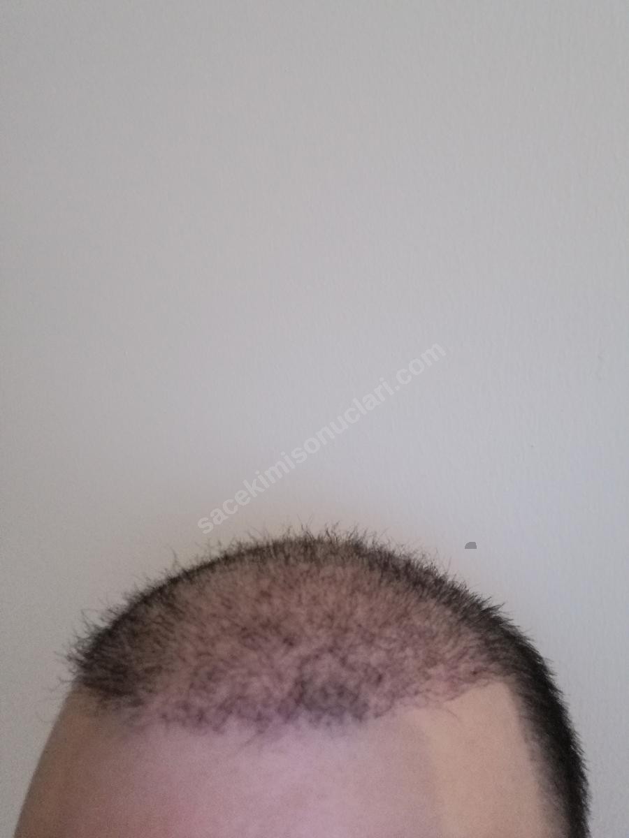 saç ekimi 25 gün