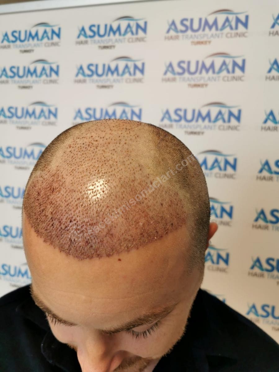 Asuman hair transplant /  / 3600 greft / yaş 36